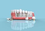 Does Medicare Cover Dental Implants? | Full Coverage Details