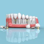 Does Medicare Cover Dental Implants? | Full Coverage Details