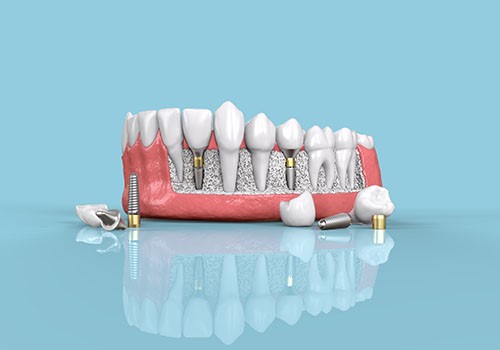 A model of a bottom jaw showing dental implants.