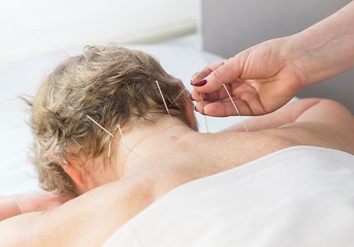 Does Medicare Cover Acupuncture? – Find The Relief You Need