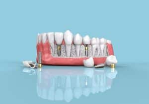 does medicare cover dental implants