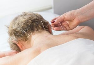 does medicare cover acupuncture